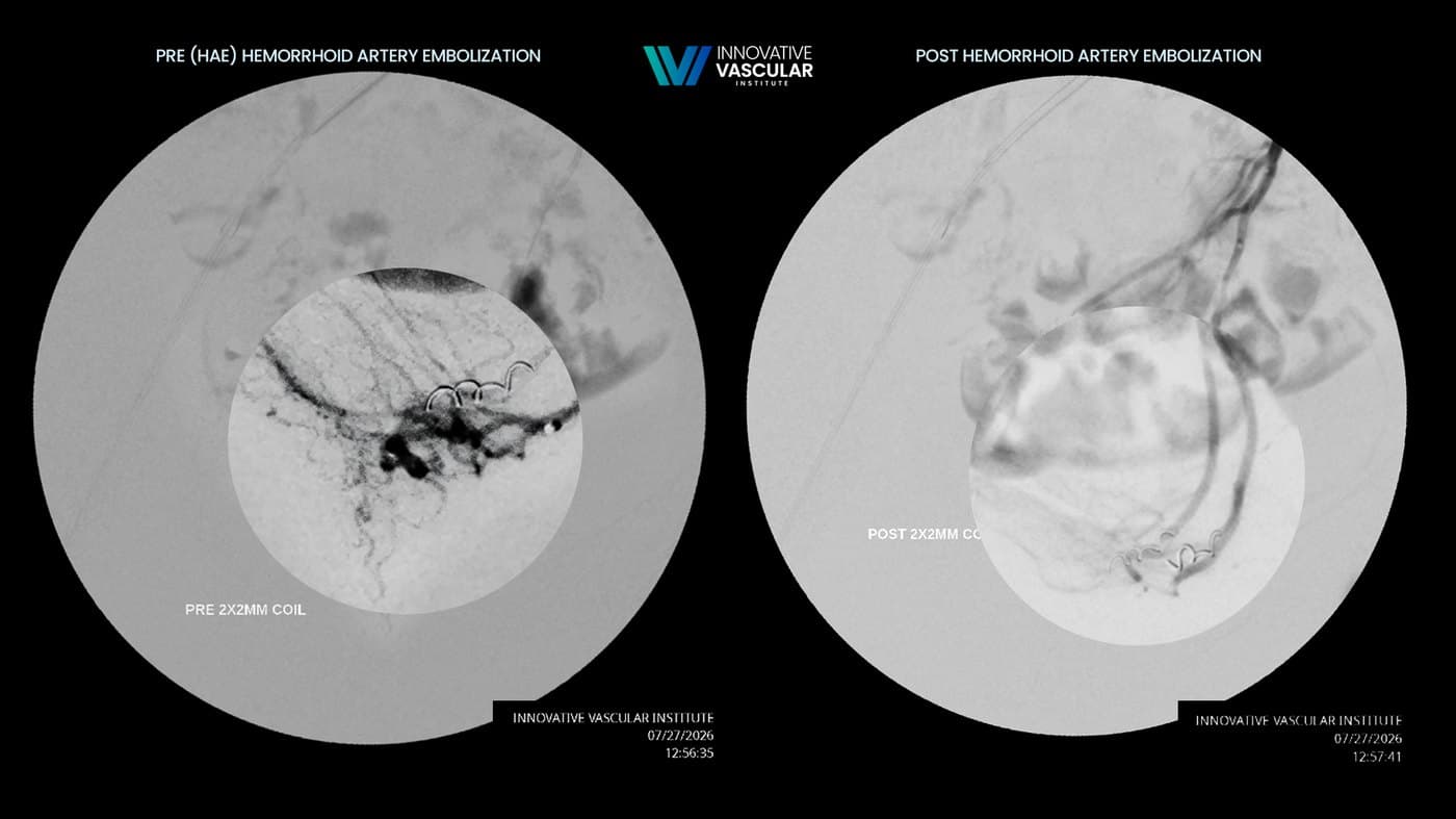 Angiograms before and after hemorrhoid artery embolization, showing reduced blood flow to the hemorrhoidal vessels
